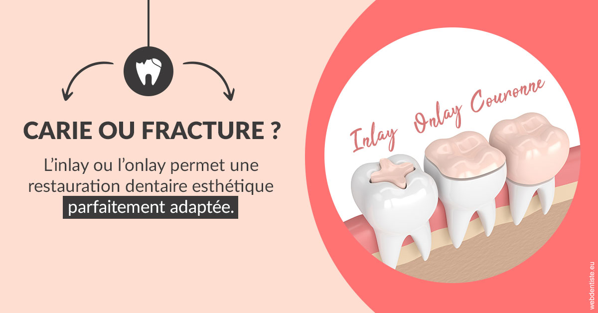 https://dr-jeannenot-luc.chirurgiens-dentistes.fr/T2 2023 - Carie ou fracture 2