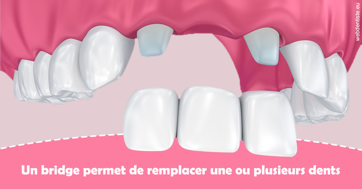 https://dr-jeannenot-luc.chirurgiens-dentistes.fr/Bridge remplacer dents 2