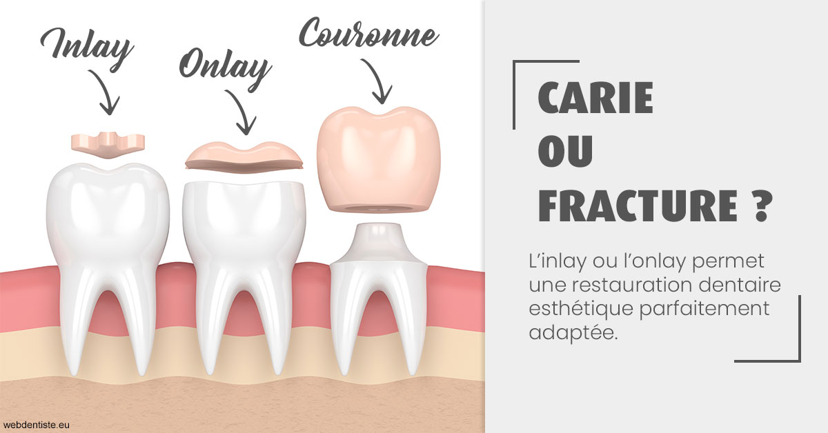 https://dr-jeannenot-luc.chirurgiens-dentistes.fr/T2 2023 - Carie ou fracture 1