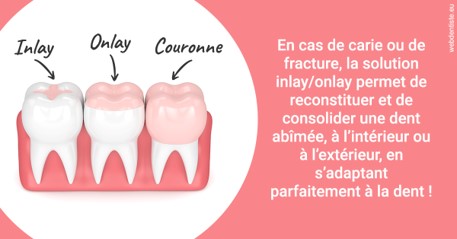 https://dr-jeannenot-luc.chirurgiens-dentistes.fr/L'INLAY ou l'ONLAY 2