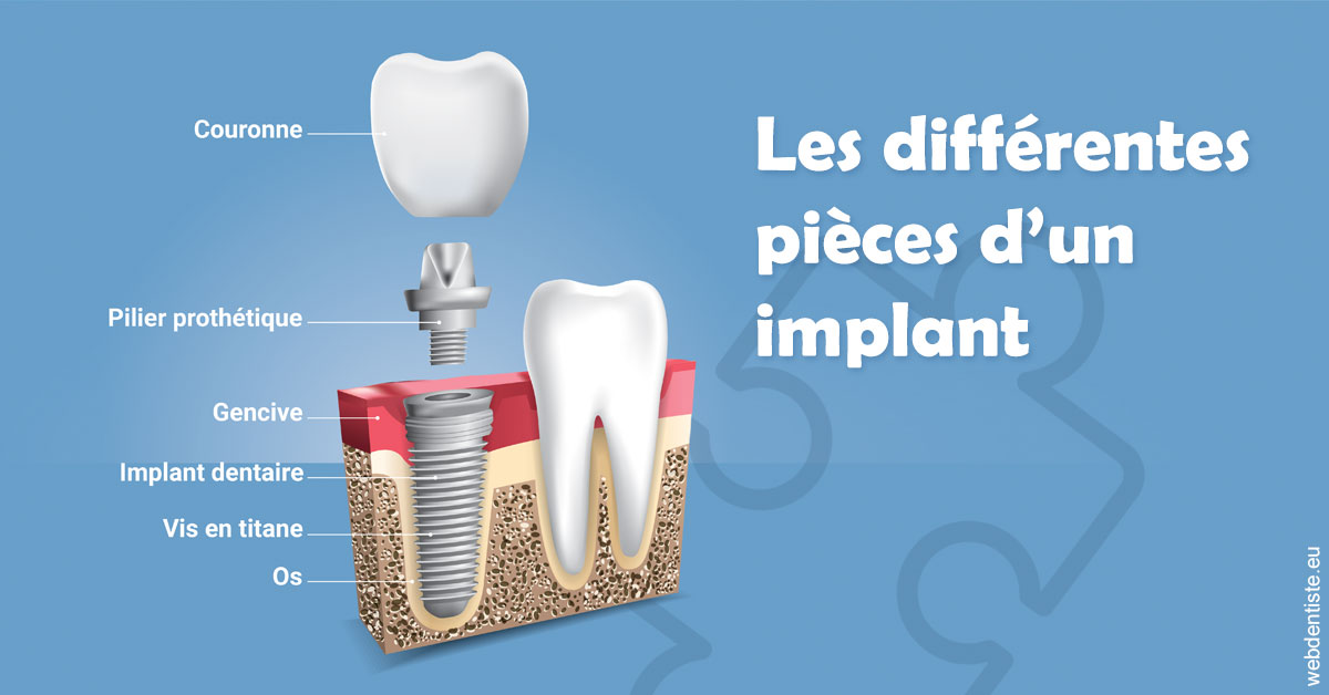 https://dr-jeannenot-luc.chirurgiens-dentistes.fr/Les différentes pièces d’un implant 1